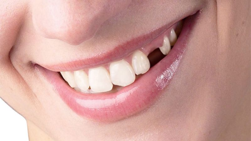 Ý nghĩa của những giấc mộng thấy rụng răng mang đến